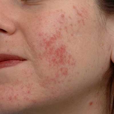 laser treatment for acne scar
