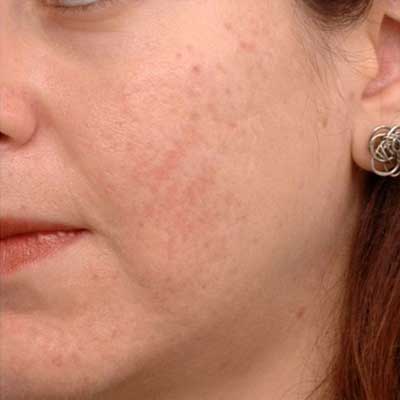 laser treatment for acne scar