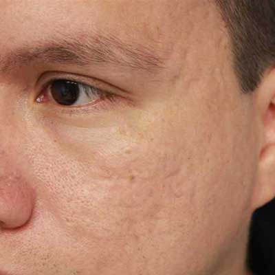 laser treatment for acne scar
