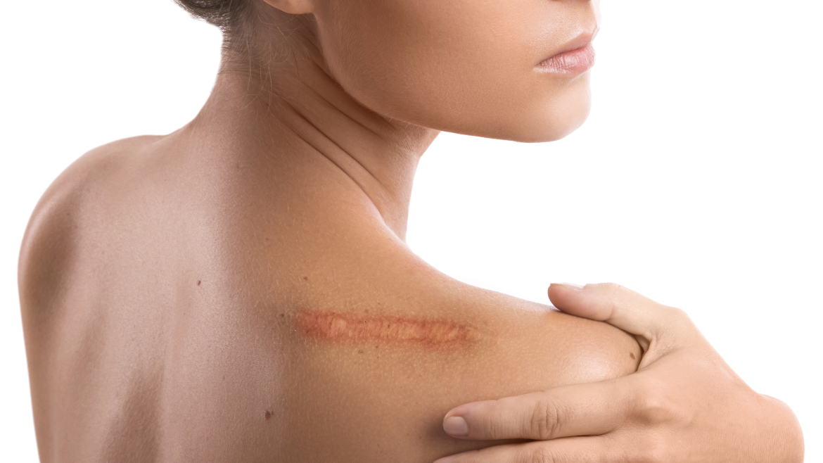 Burn Scars Removal