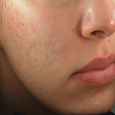 pore-reduction-before