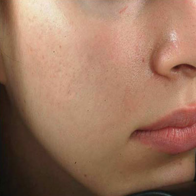 pore-size-reduction-after1