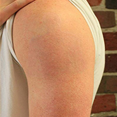 tattoo removal mangalore