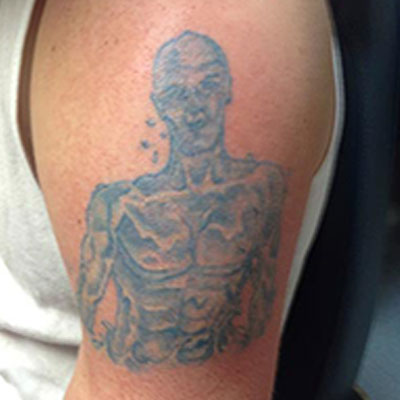 tattoo removal mangalore