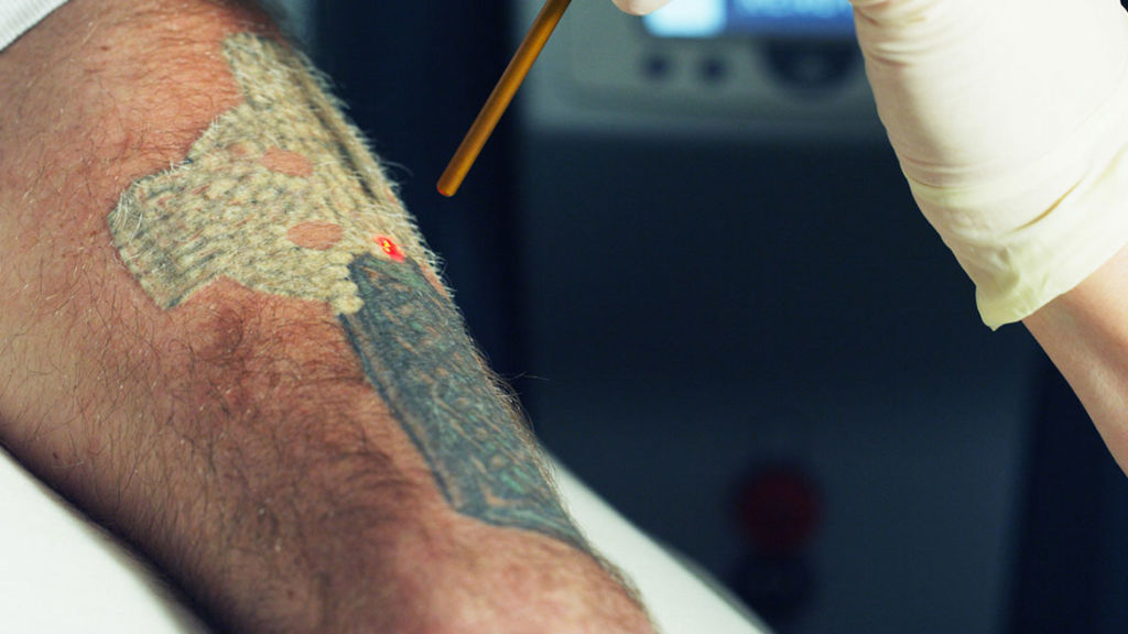 Permanent Tattoo Removal Simply Better Skin
