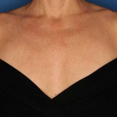 neck and chest rejuvenation before and after