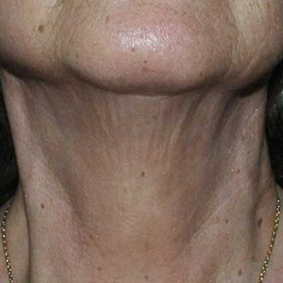 neck and chest rejuvenation before and after
