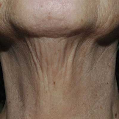 neck and chest rejuvenation before and after