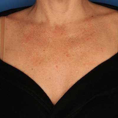 neck and chest rejuvenation before and after
