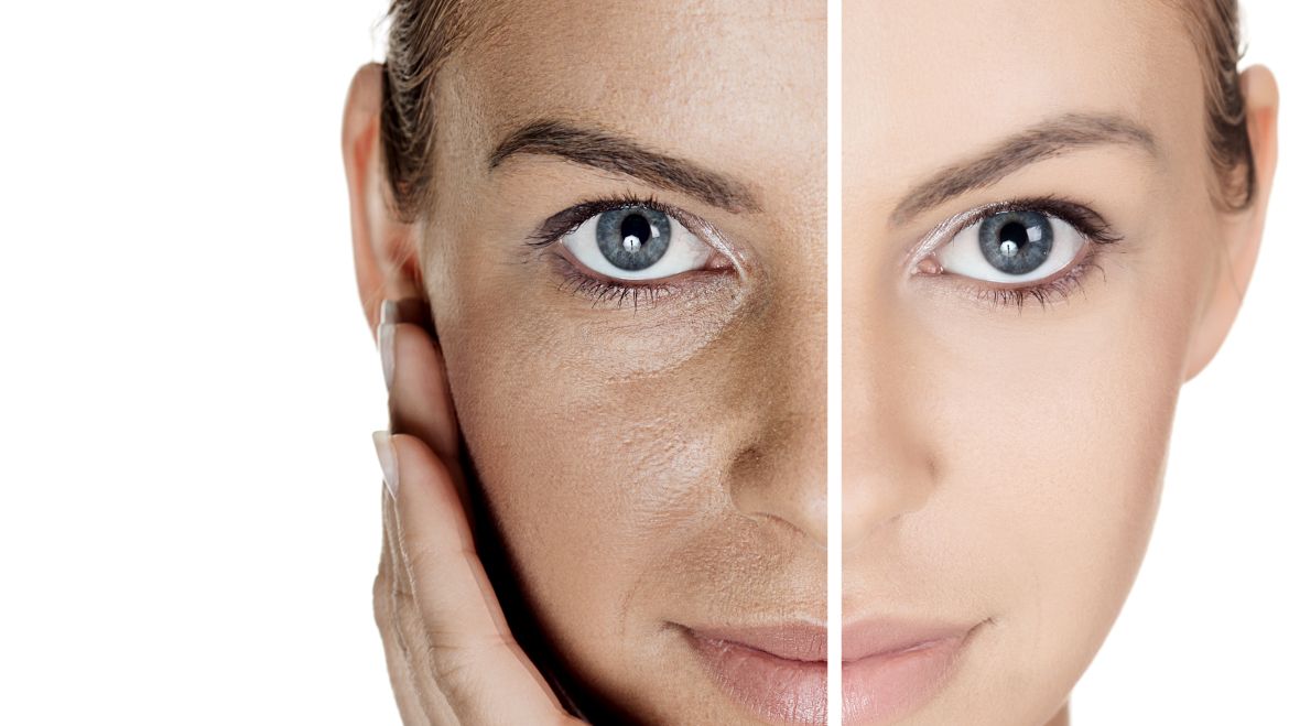 Photo Aging & Pigmentation
