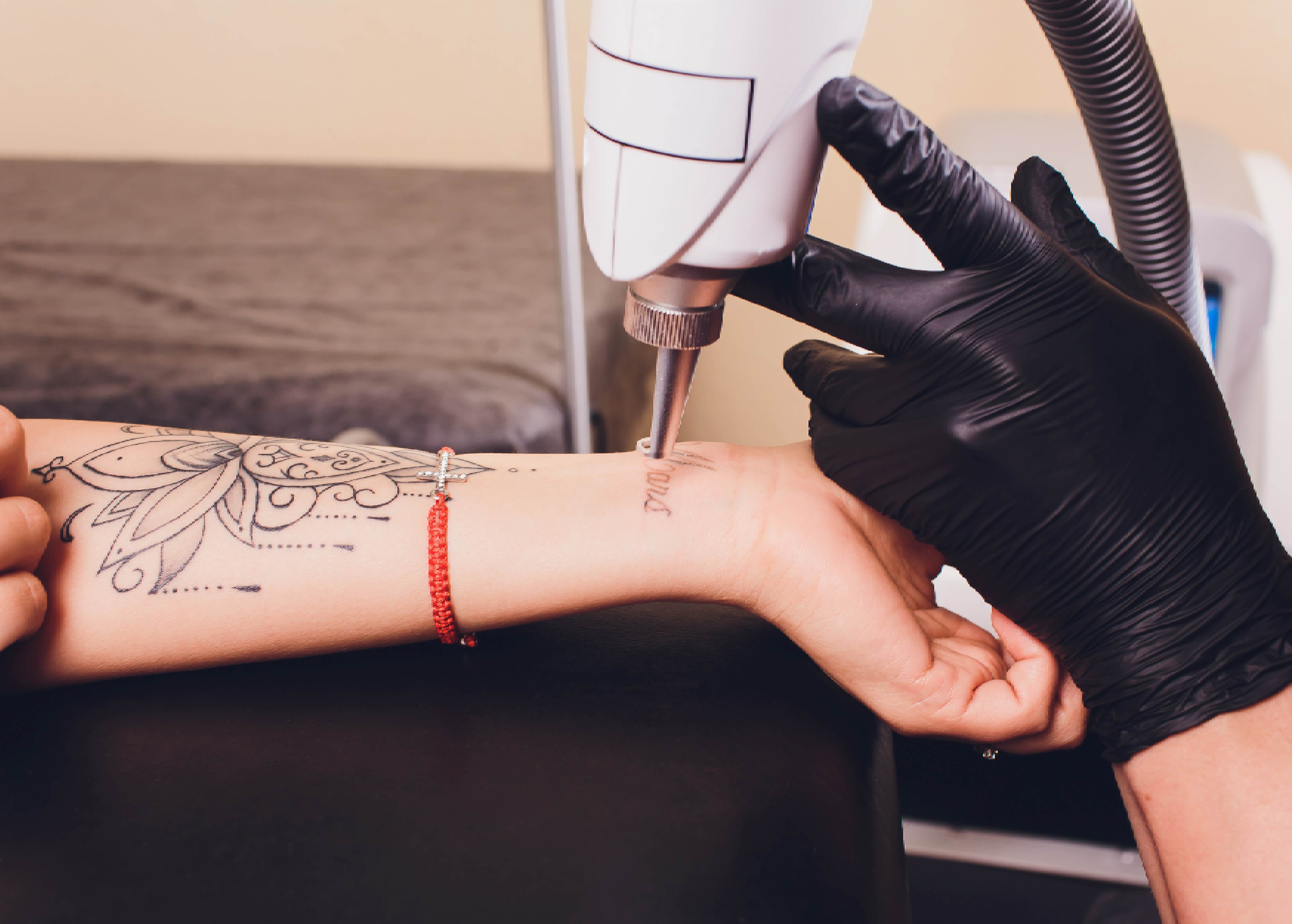 Tattoo Removal
