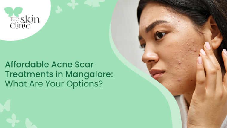 Acne Scar Treatments in Mangalore
