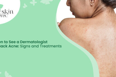Dermatologist for Back Acne