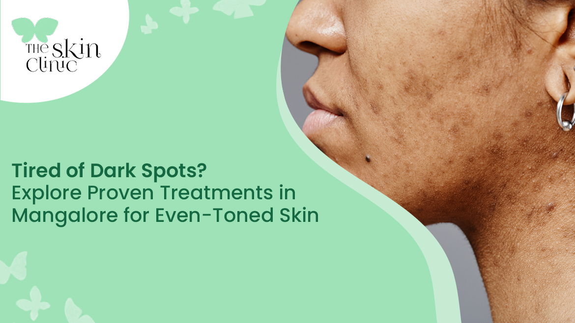 Dark Spots Treatment in Mangalore