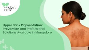Upper Back Pigmentation Treatments in Mangalore: Prevention and Professional Solutions