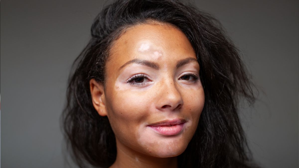 Pigmentation & Melasma Therapy